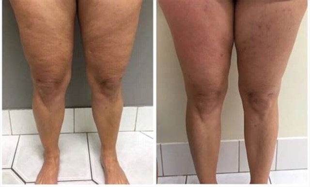 Cellulite Removal Certificates 